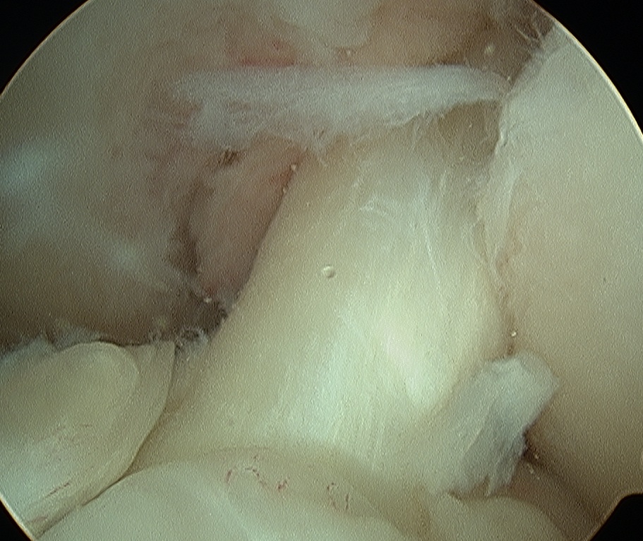 ACL Old Partial Tear Taut with Anterior Draw Arthroscopy
